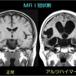 アルツハイマー