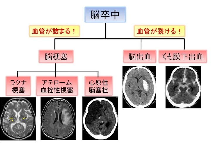 脳卒中